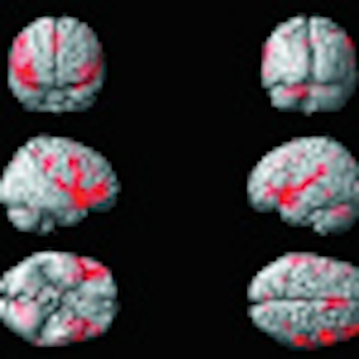 Photo 1: Brain activation map following intranasally applied nicotine stimuli in concentrations at or slightly above individual olfactory detection thresholds; view 1