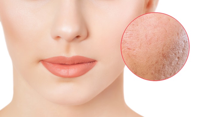 Neoporyl is a cosmetic ingredient that was clinically proven to reduce pore size in just one week. Crafted by biocatalysis, it targets the root causes of enlarged pores by acting on parakeratosis and dermis fragility.