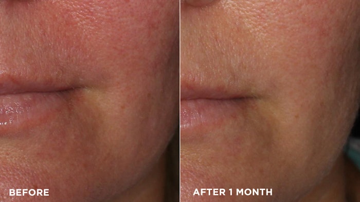 Woman before and after smile lines treatment