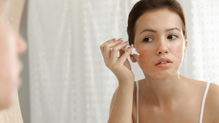 Teen girl with acne problem applying cream near mirror in bathroom