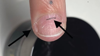 The nail has not been prepped.