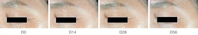 Twice daily application of 1% SYN-UP™ significantly reduced wrinkle volume on the crow’s feet.