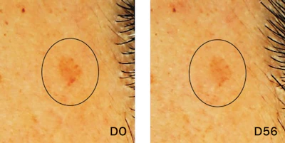 Age spots were noticeably lighter and smaller.
