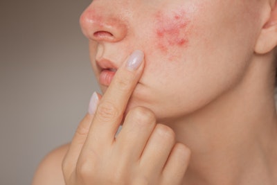 Skin inflammation and atopic dermatitis are common skin concerns that are driving innovation within the skin care and ingredient manufacturing industry.