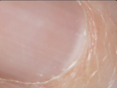 After Pushing Back The Cuticle