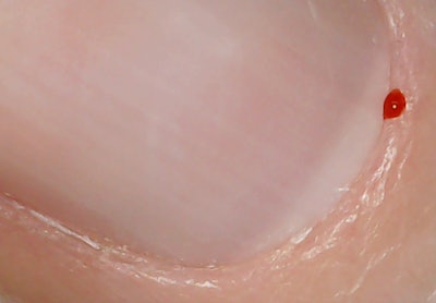 Living Tissue Also Removed