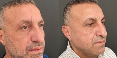 Neo Elite treatment for traumatic scar