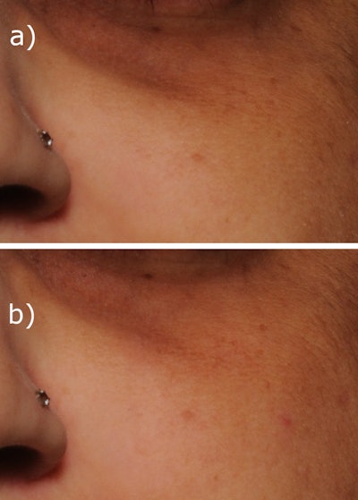Under-eye area at T0 (a) and T56 days (b)