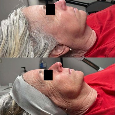 Patient results after Neo Elite and Era Elite.