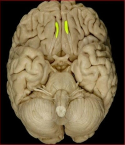 Fig. 2: View of the human olfactory bulbs in yellow