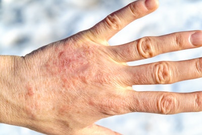 Winter can further exacerbate eczema since cold air can't hold onto moisture as well.
